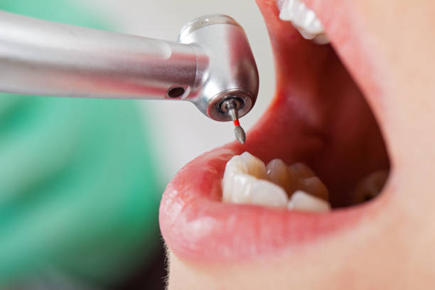 Best Emergency Tooth Extraction in Osgood, IN